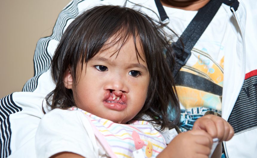 Cleft Lip & Cleft Palate – Manila, Philippines